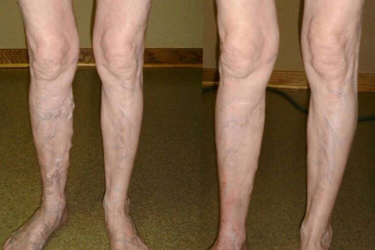 varizes veias em homens