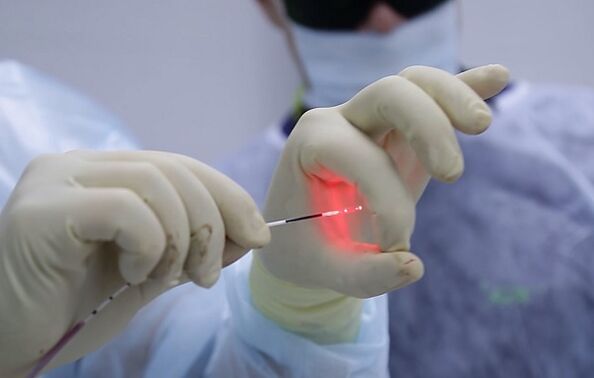 Fibra a laser