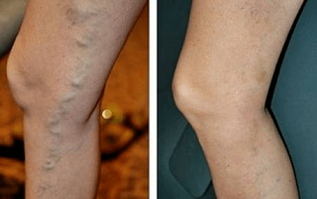 varizes antes e depois
