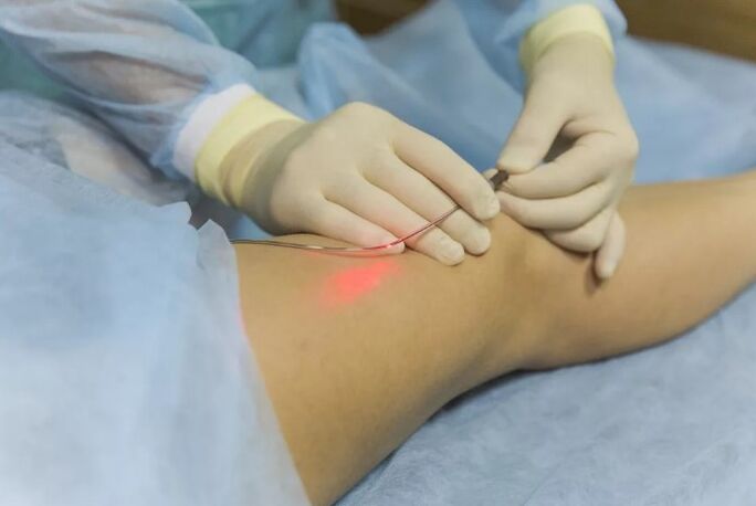 Tratamento de varizes veias com um laser