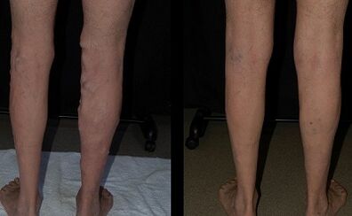 Tratamento de varizes com uma foto a laser antes e depois