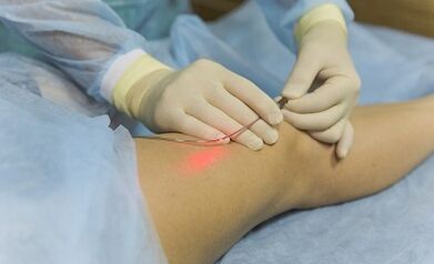 Tratamento de varizes veias com um laser